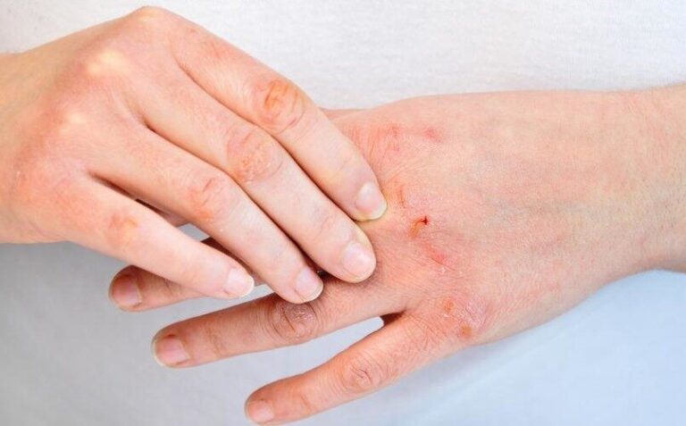 29 октября- Всемирный день борьбы с псориазом